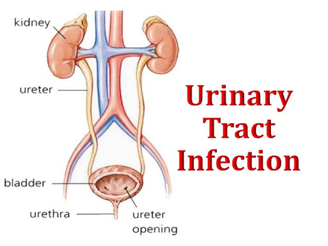 NUR226 Management of Catheter-Associated Urinary Tract Infection Assignment Sunshine Coast University AU 2 NUR226 Management of Catheter-Associated Urinary Tract Infection